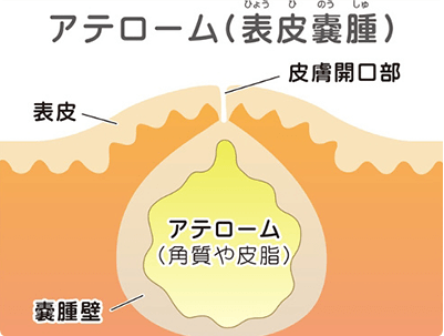 粉瘤の治療なら日暮里泌尿器科内科 荒川区 足立区 北区 文京区 台東区